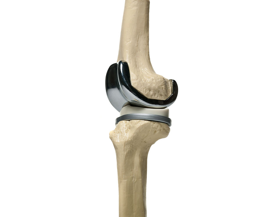 Total Knee & Joint Replacement San Antonio TX | Bone & Joint Institute