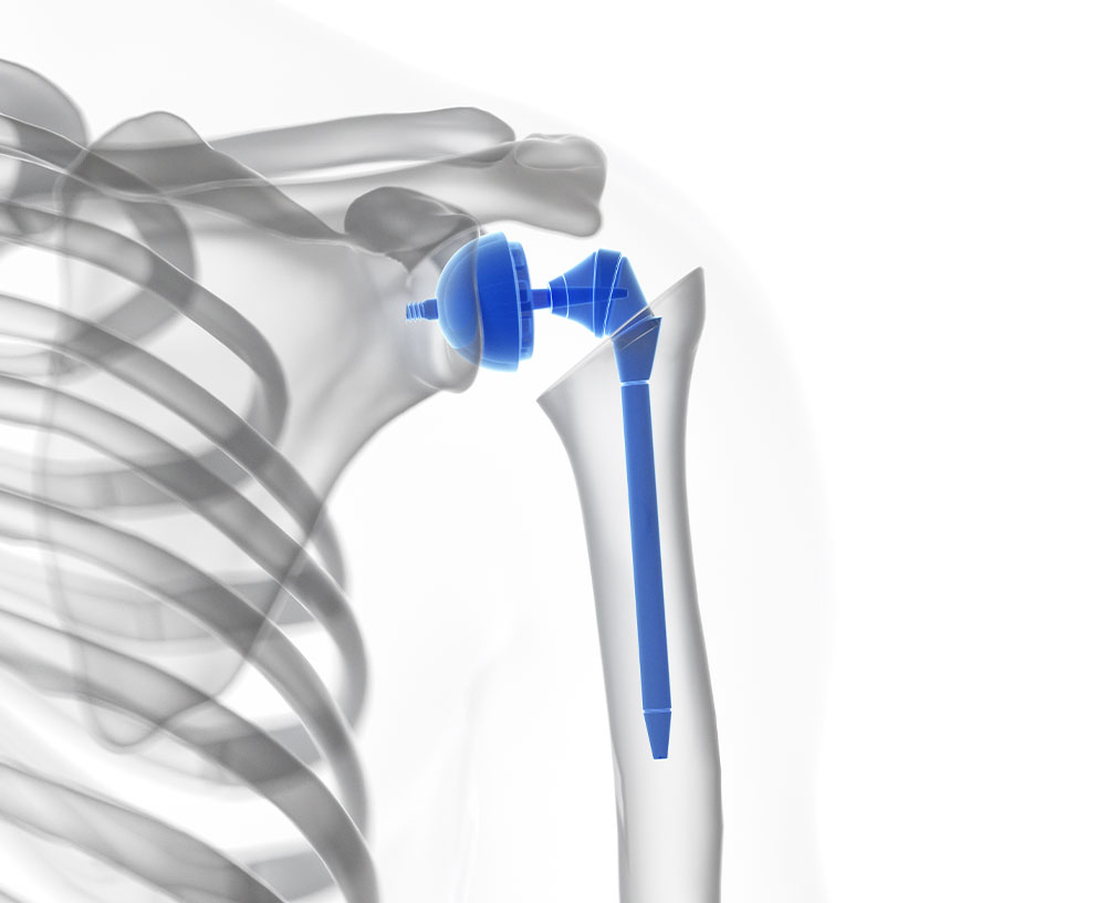 Shoulder Replacement Surgery San Antonio TX Bone & Joint Institute